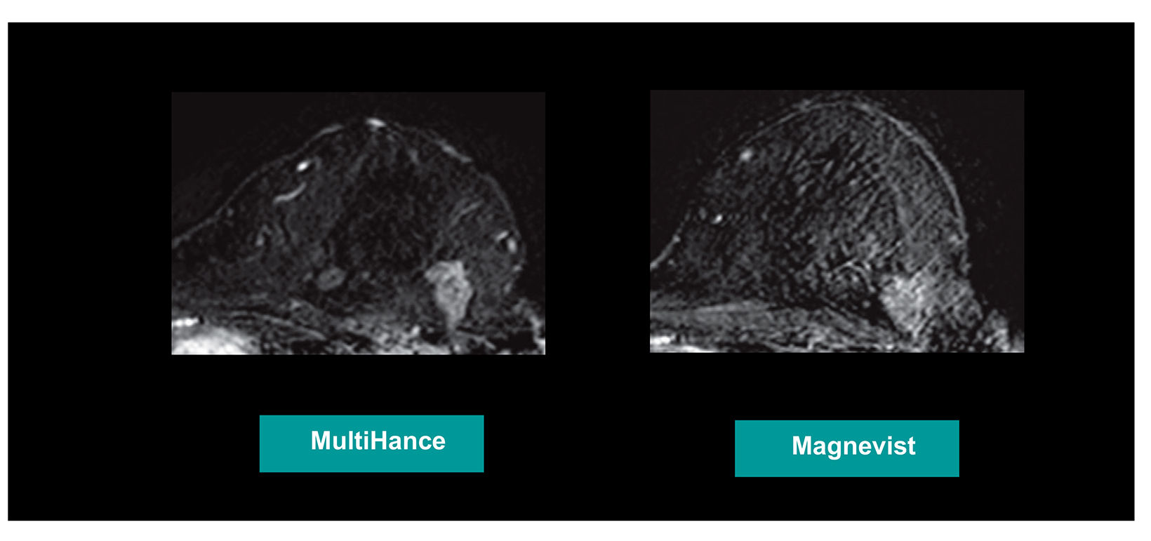 Can machine learning reduce breast MRI contrast dose?