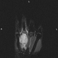 Giant Cell Tumor Applied Radiology Giant Cell Tumor Applied Radiology