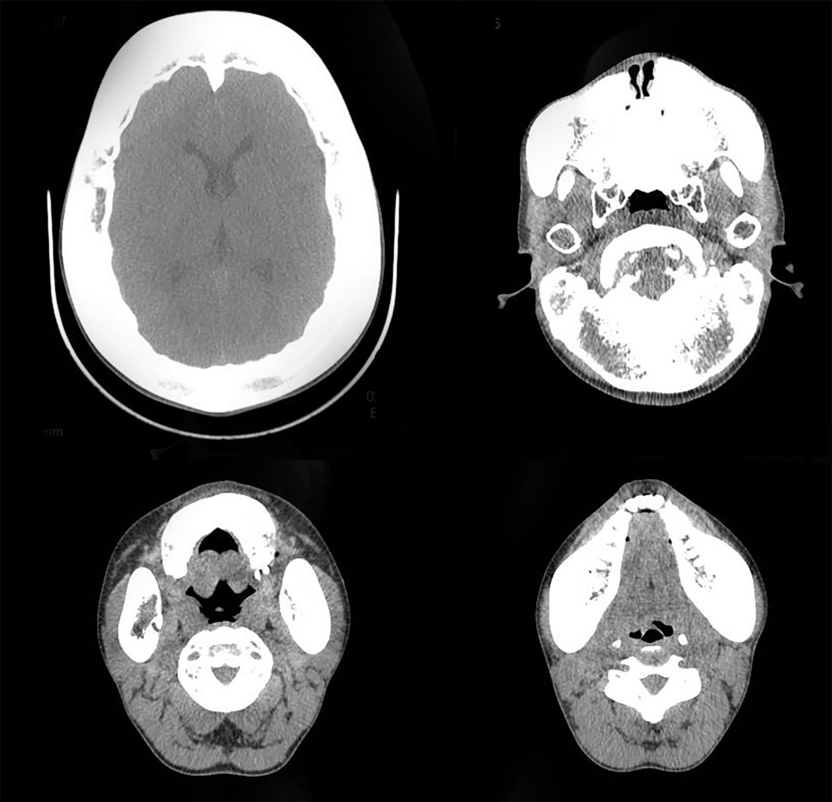 Craniometaphyseal dysplasia radiology