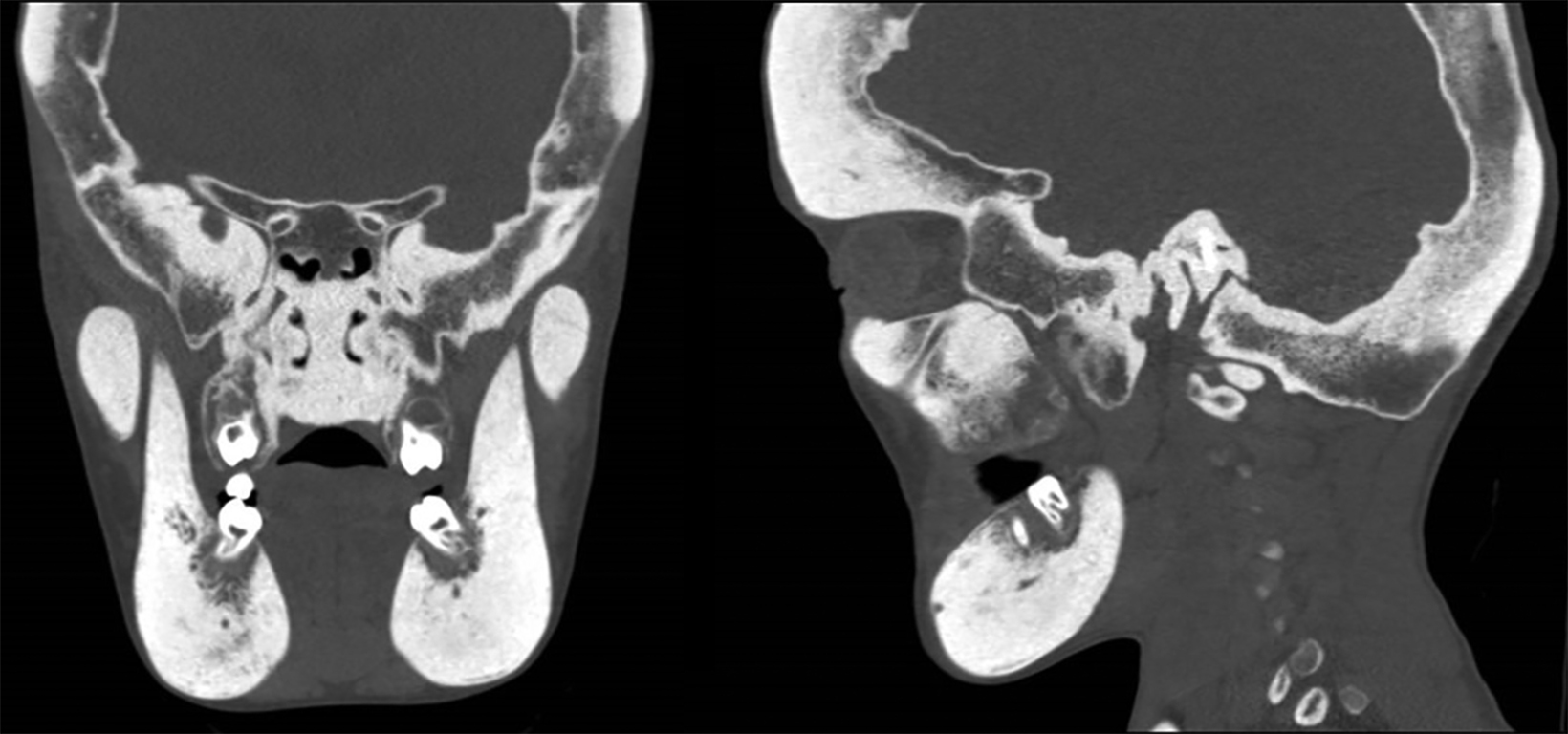 Craniometaphyseal dysplasia radiology