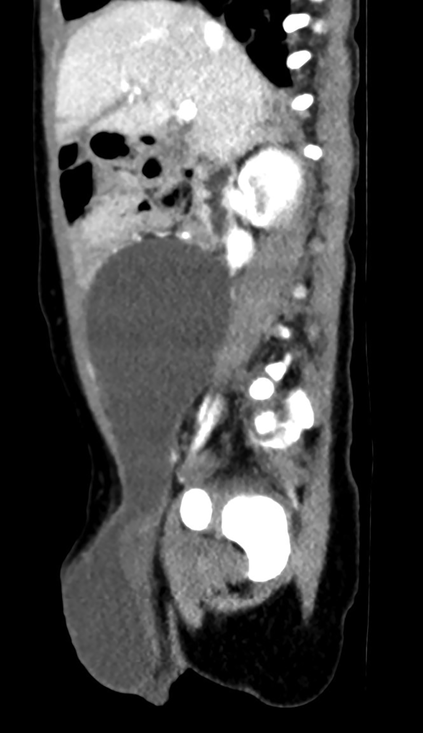 bilateral-abdomino-scrotal-hydrocele-applied-radiology