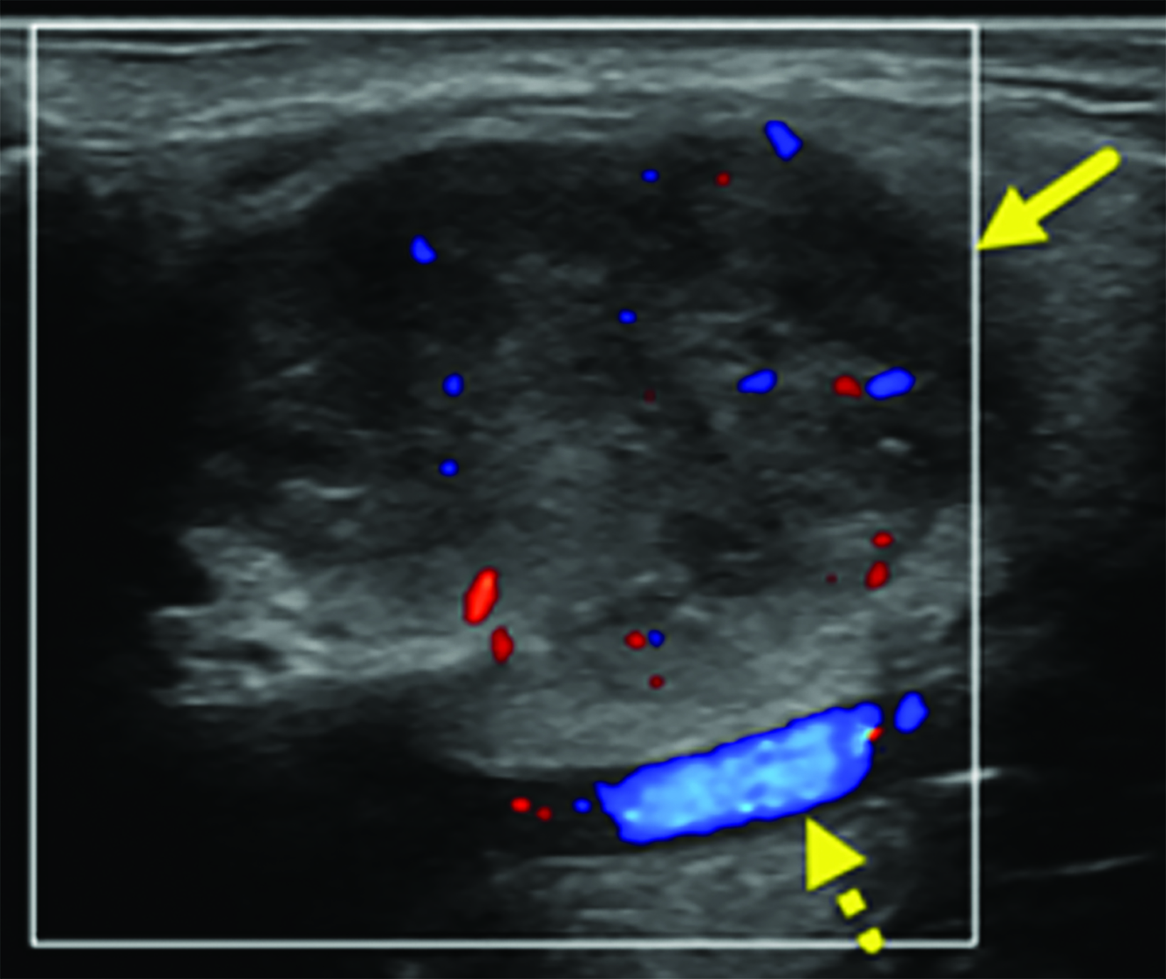 Pleomorphic Adenoma Of The Parotid Gland Applied Radiology