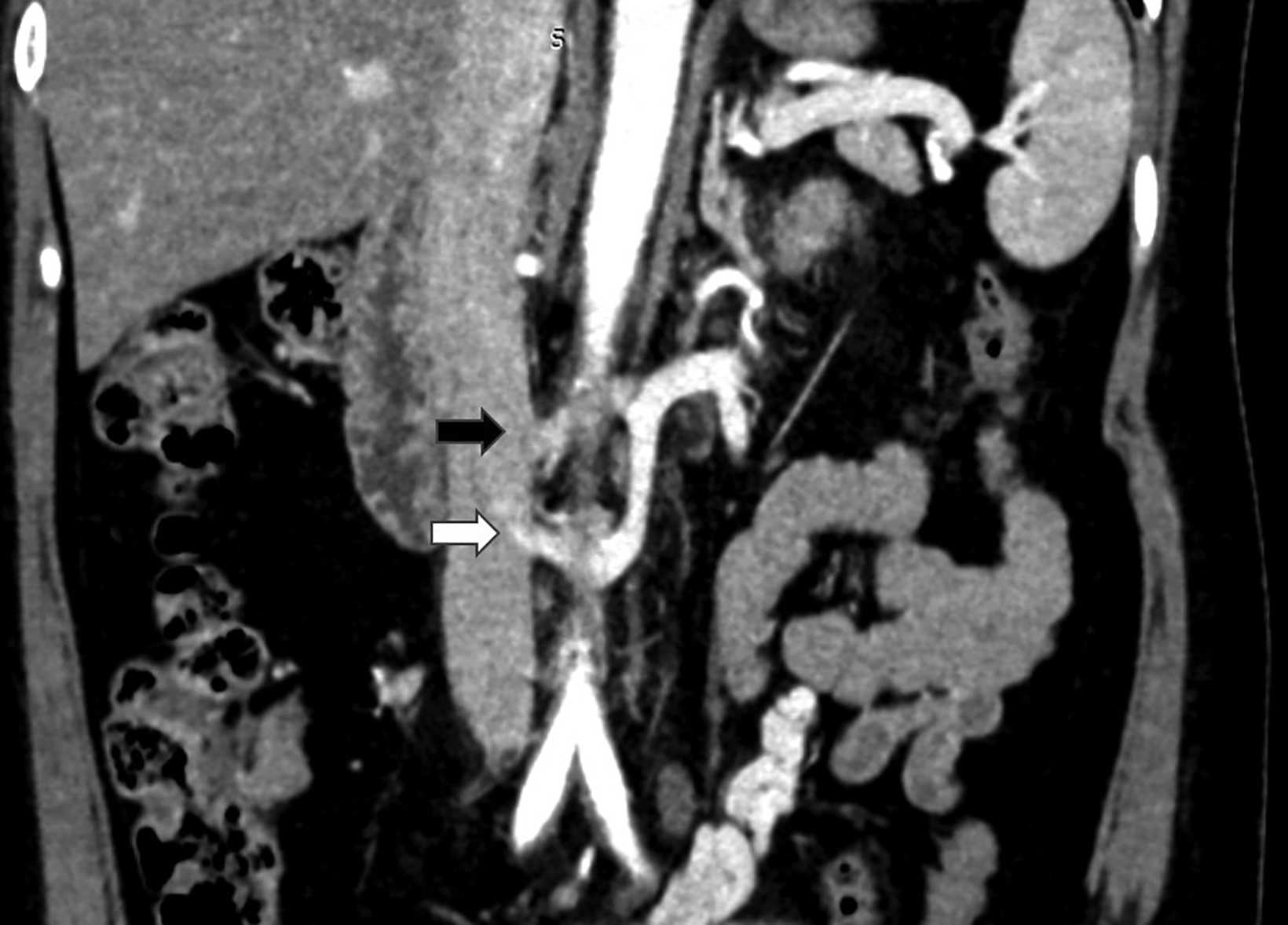 Pelvic congestion syndrome, Radiology Case