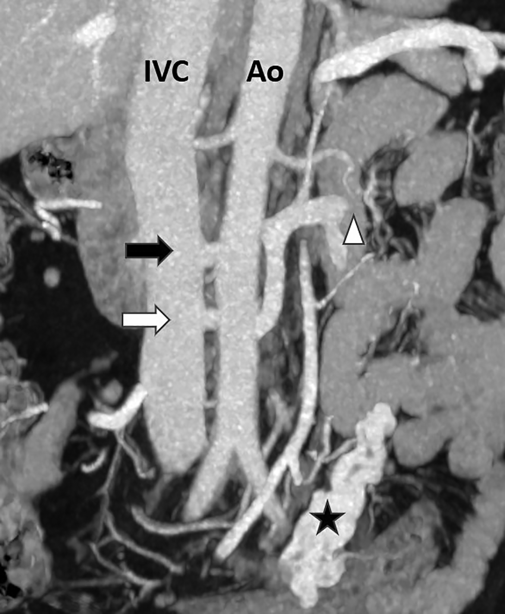 Posterior Nutcracker Syndrome with Left Renal Vein Duplication