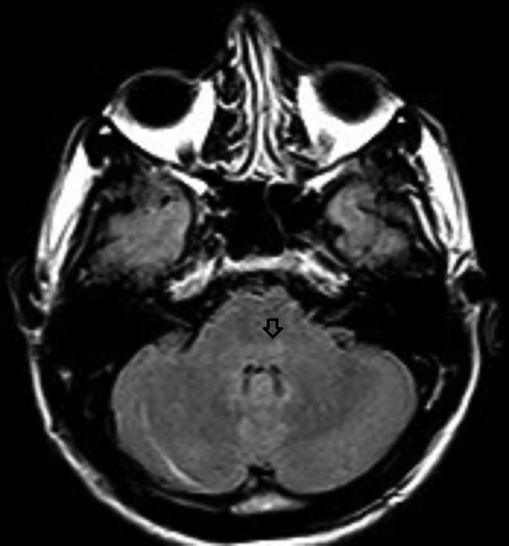 Thoracic Outlet Syndrome: Review of Surgical Approaches and