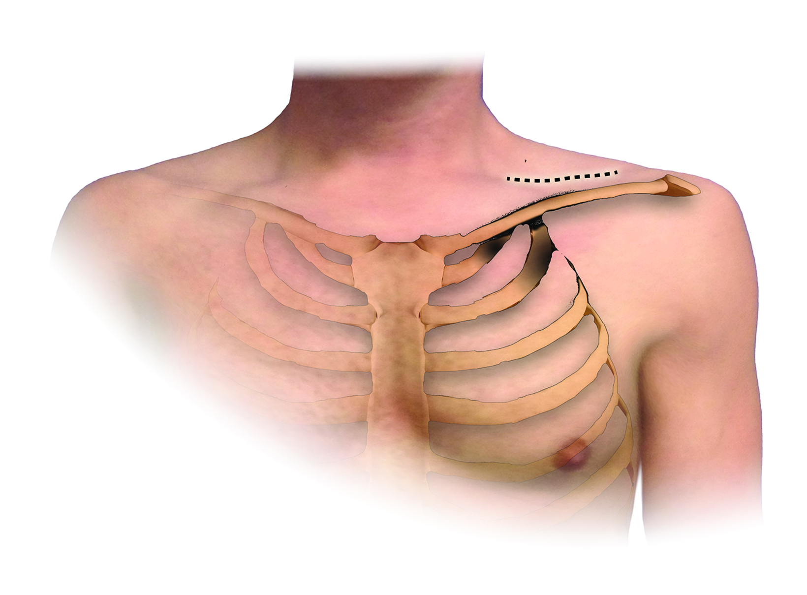 Thoracic outlet syndromes