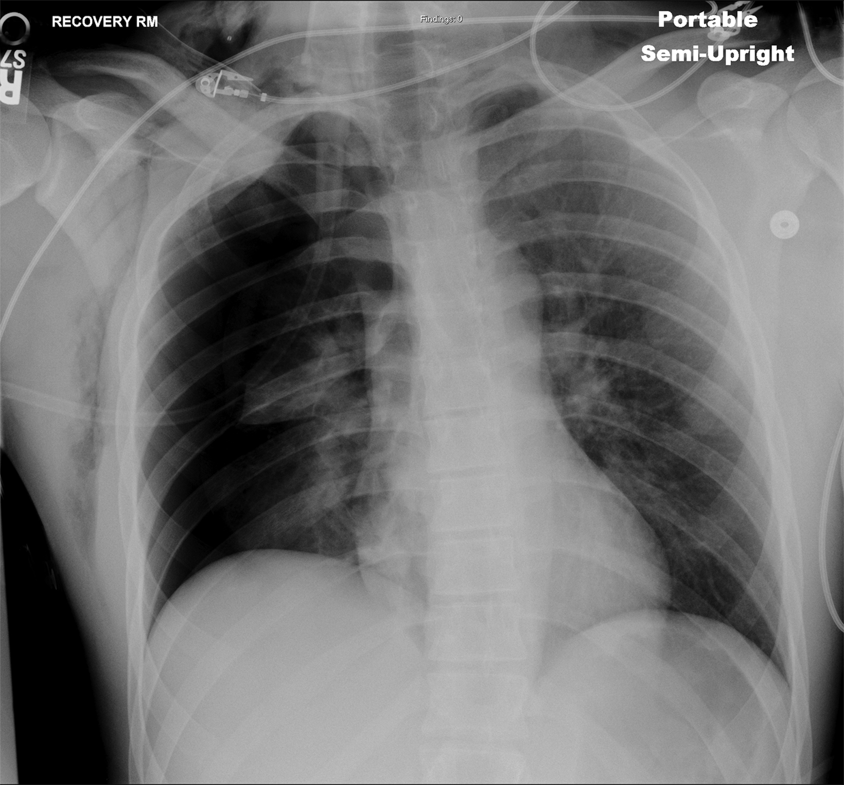 Thoracic Outlet Syndrome: Review of Surgical Approaches and Radiographic  Complications • APPLIED RADIOLOGY