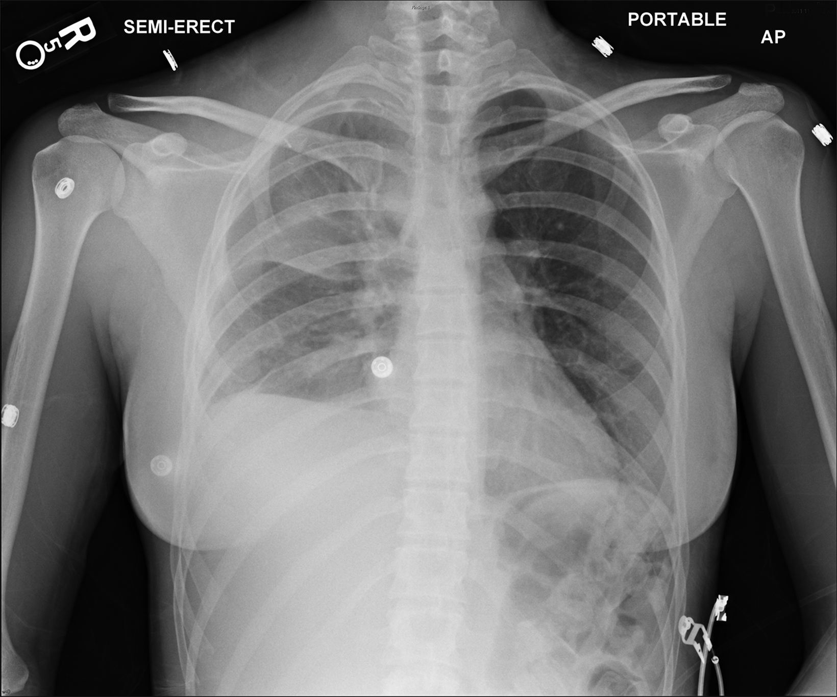 Thoracic outlet syndromes