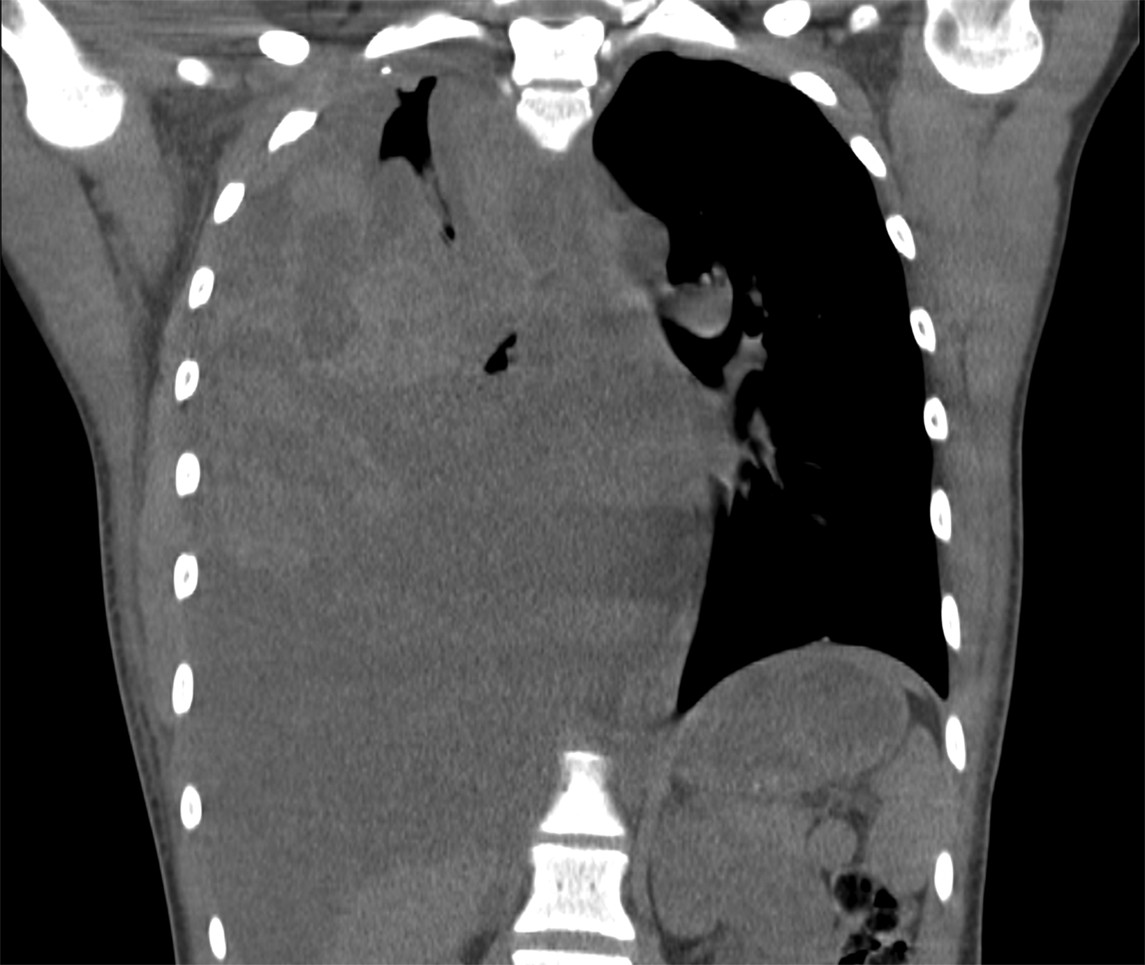 Thoracic Outlet Syndrome: Review of Surgical Approaches and