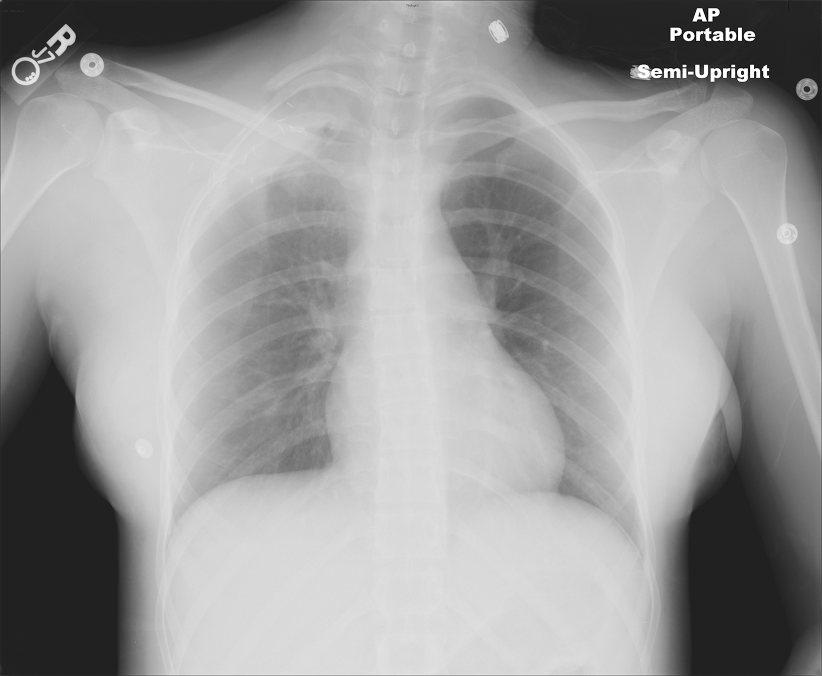 Thoracic Outlet Syndrome: Review of Surgical Approaches and