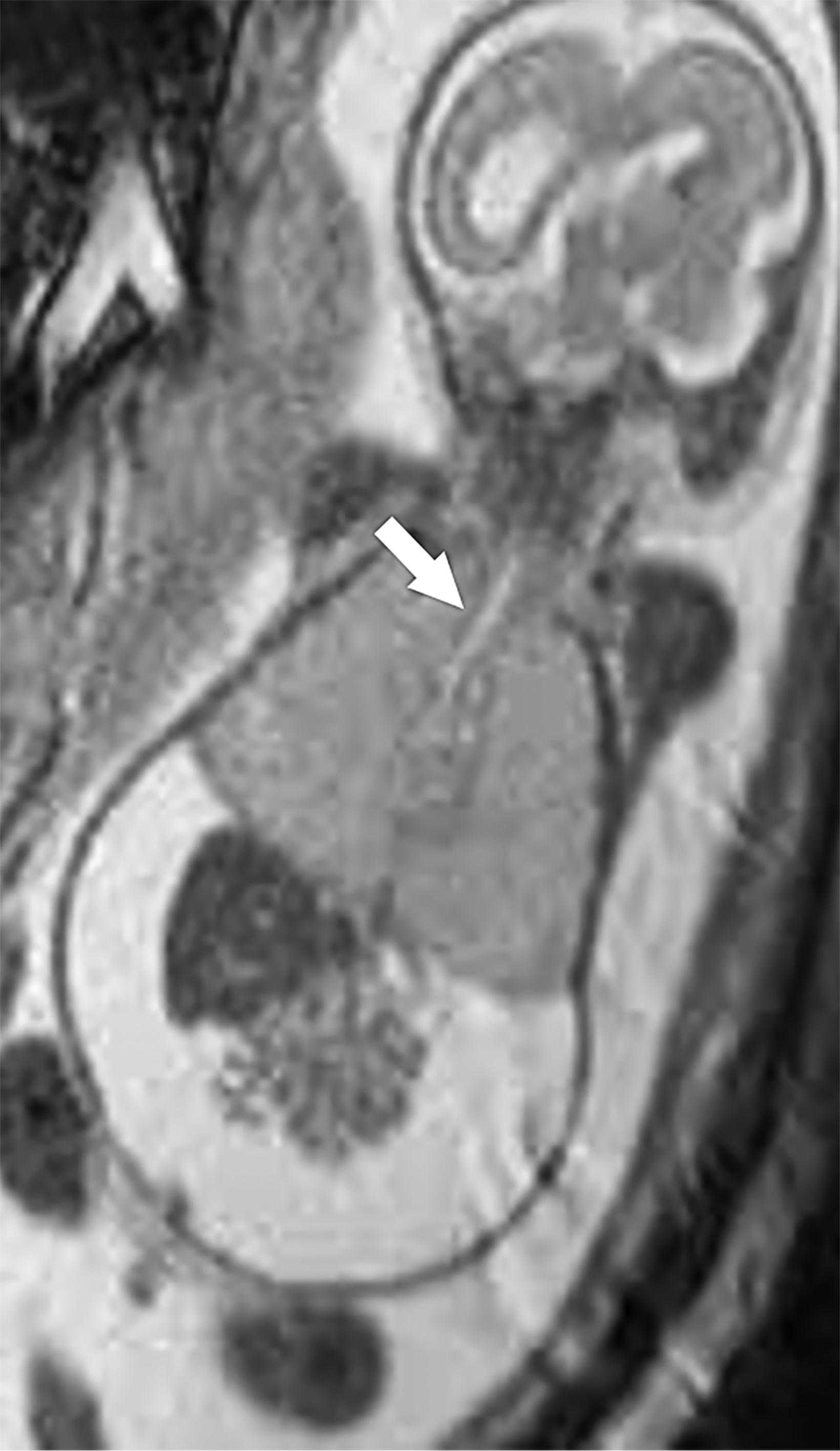 Thoracic Outlet Syndrome: Review of Surgical Approaches and