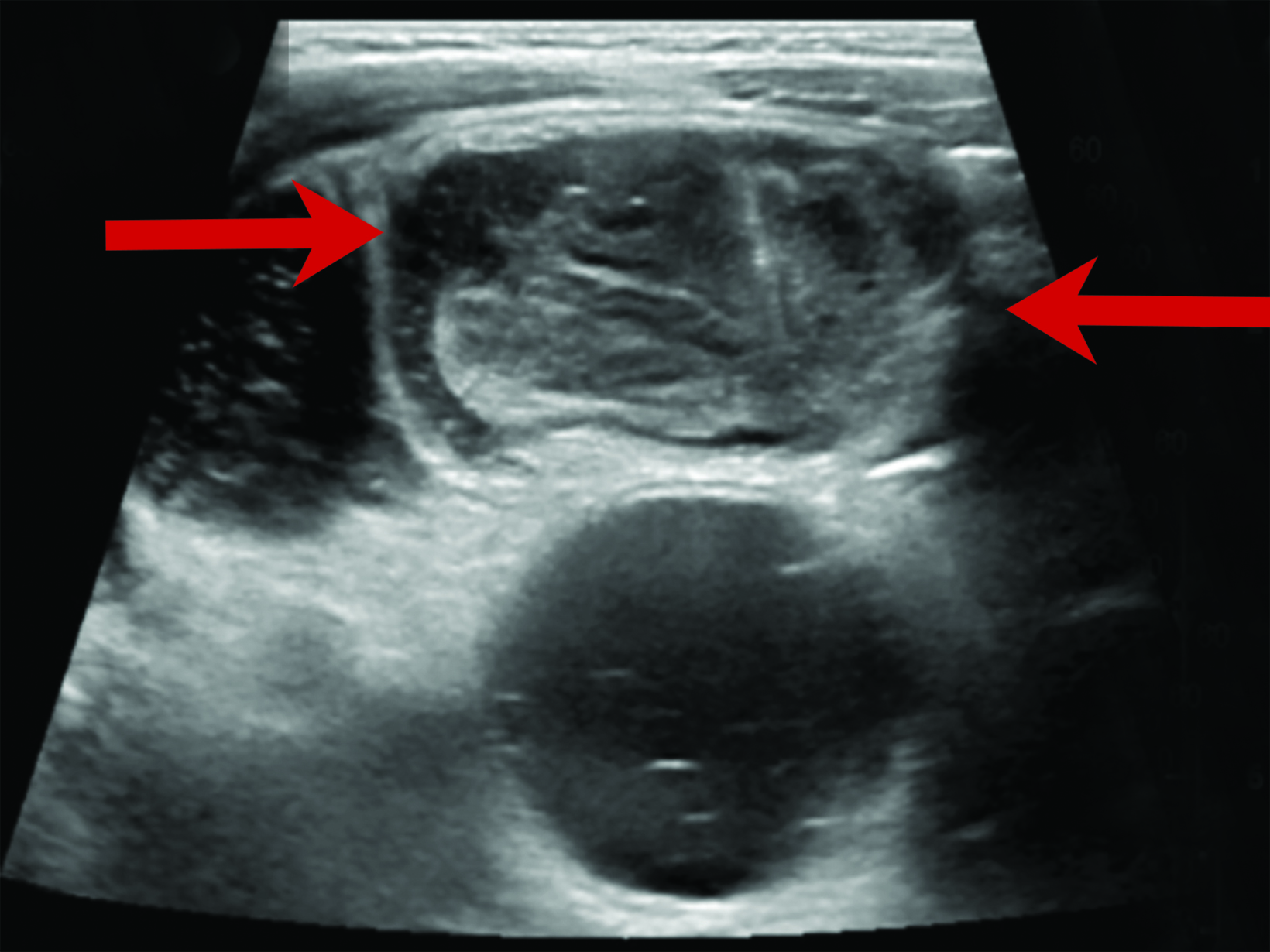 Thoracic Outlet Syndrome: Review of Surgical Approaches and