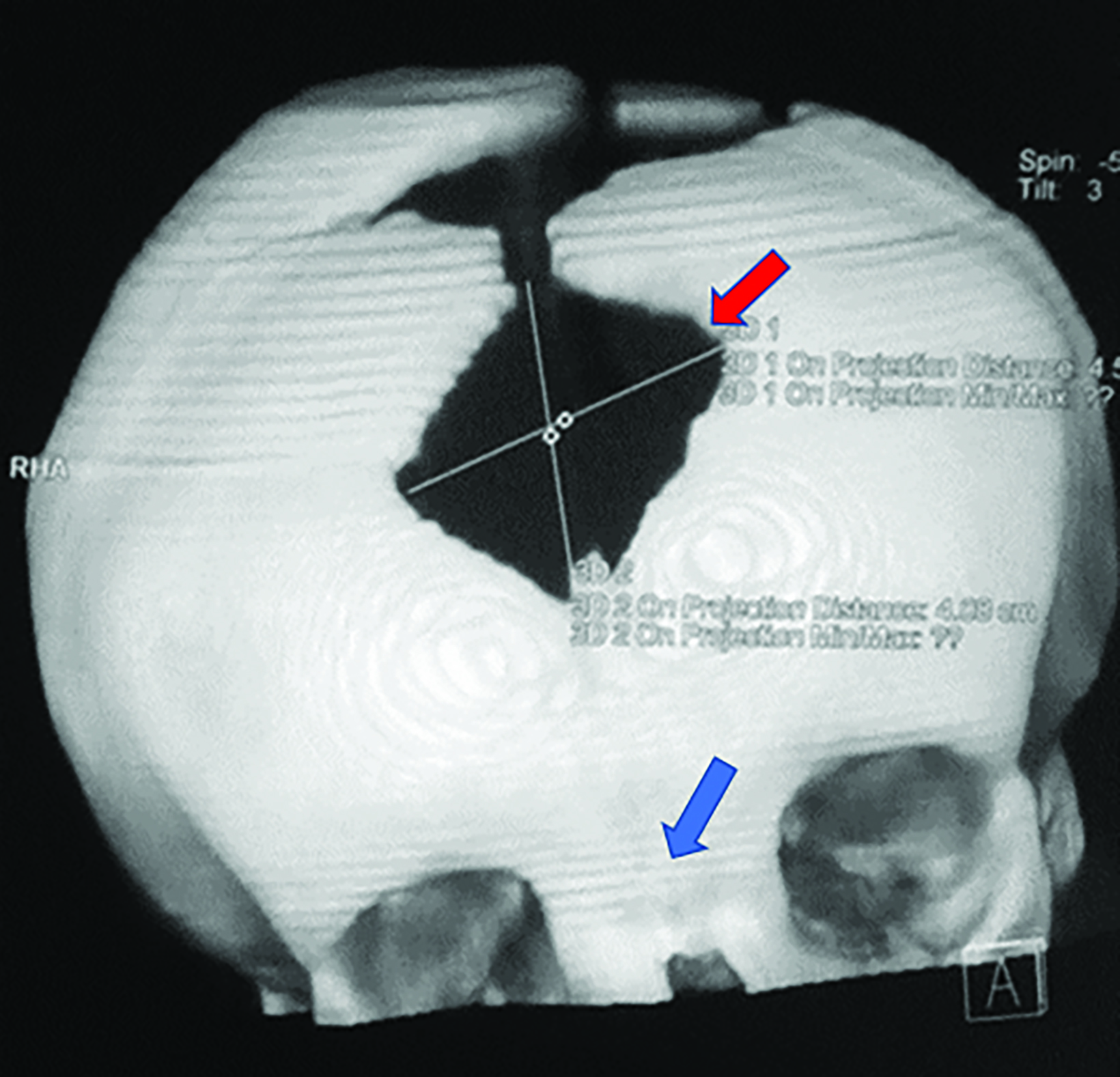 A): bell-shaped chest of the patient with cleidocranial dysplasia