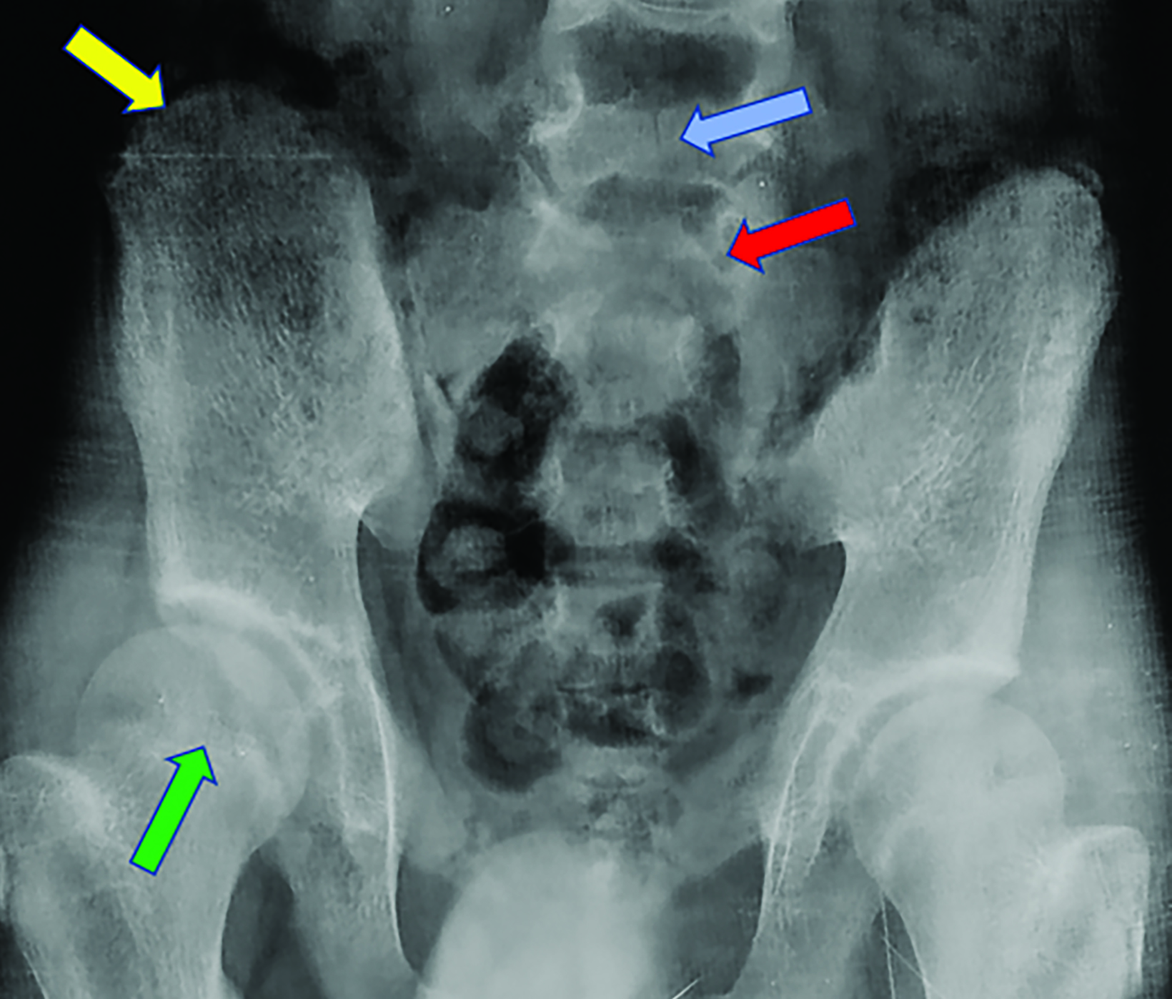 A): bell-shaped chest of the patient with cleidocranial dysplasia