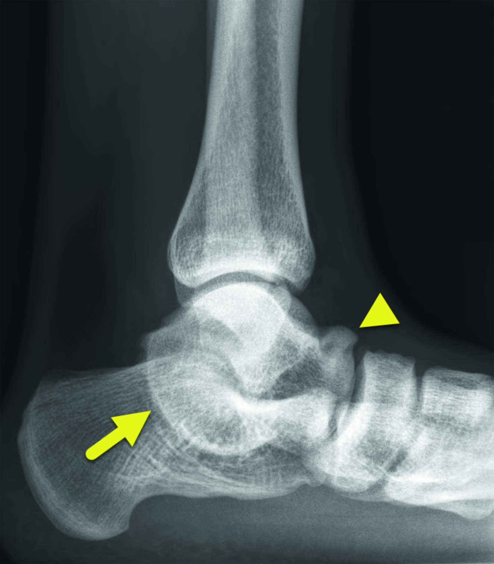 Talocalcaneal Coalition • APPLIED RADIOLOGY