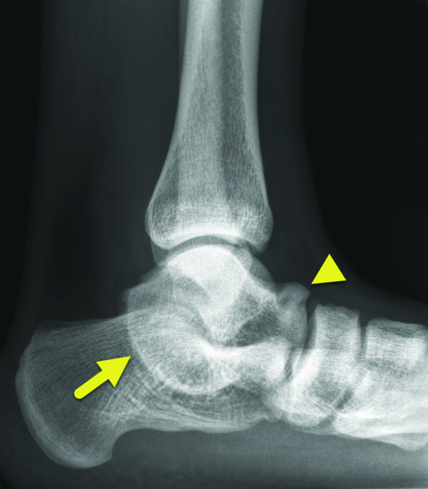 sustentaculum tali x ray