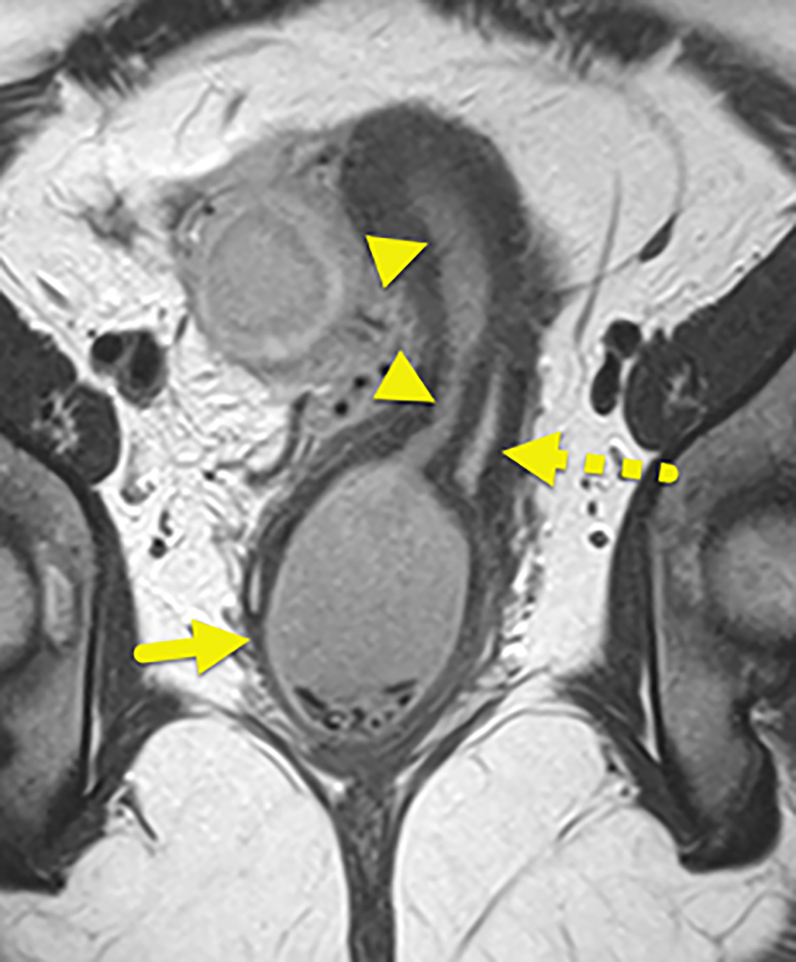 Thoracic Outlet Syndrome: Review of Surgical Approaches and