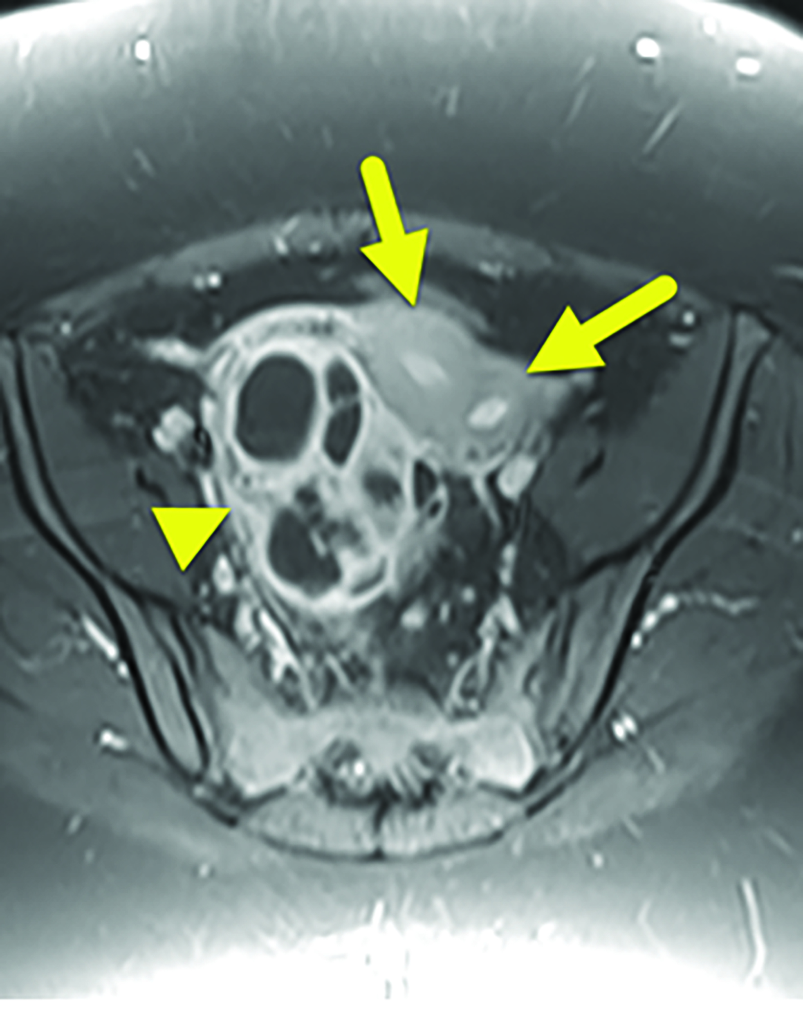 Thoracic Outlet Syndrome: Review of Surgical Approaches and