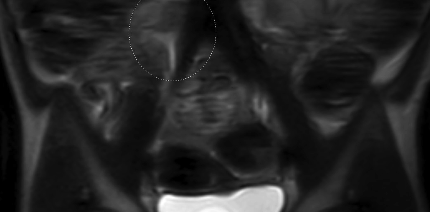 Thoracic Outlet Syndrome: Review of Surgical Approaches and