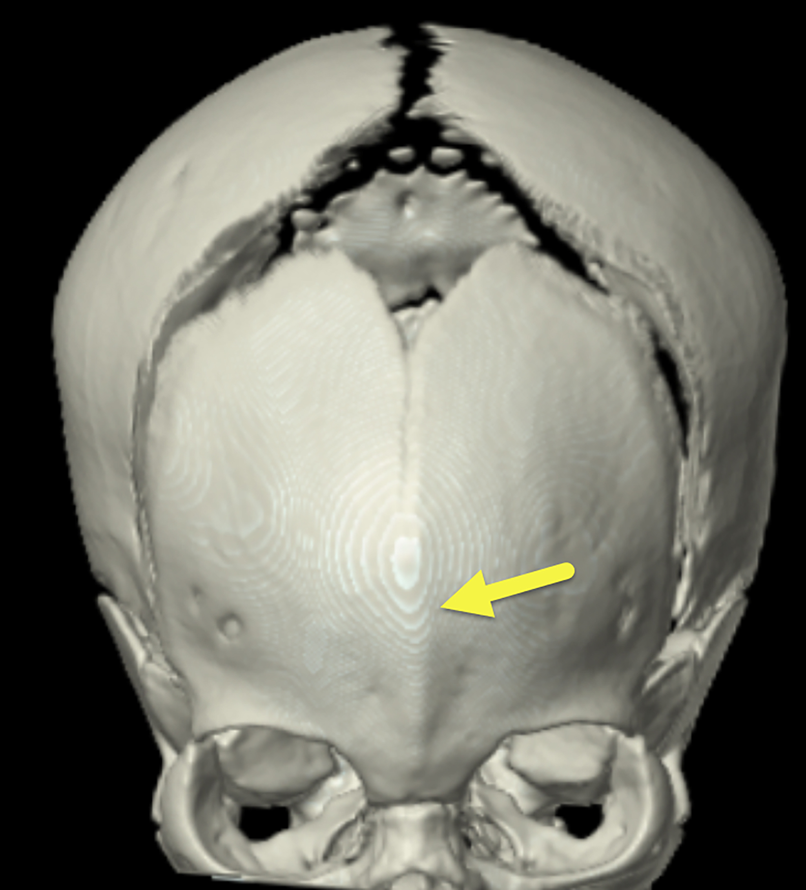 Trigonocephaly