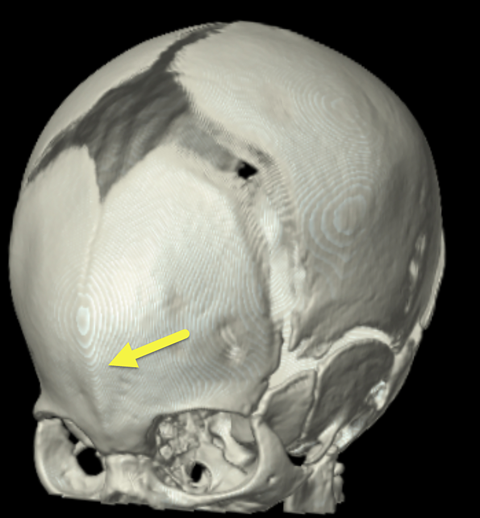 metopic synostosis