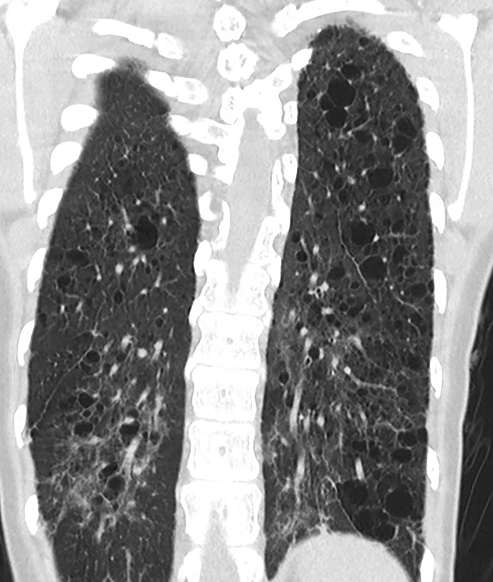 Surfactant Protein C Deficiencyassociated Diffuse Lung Disease