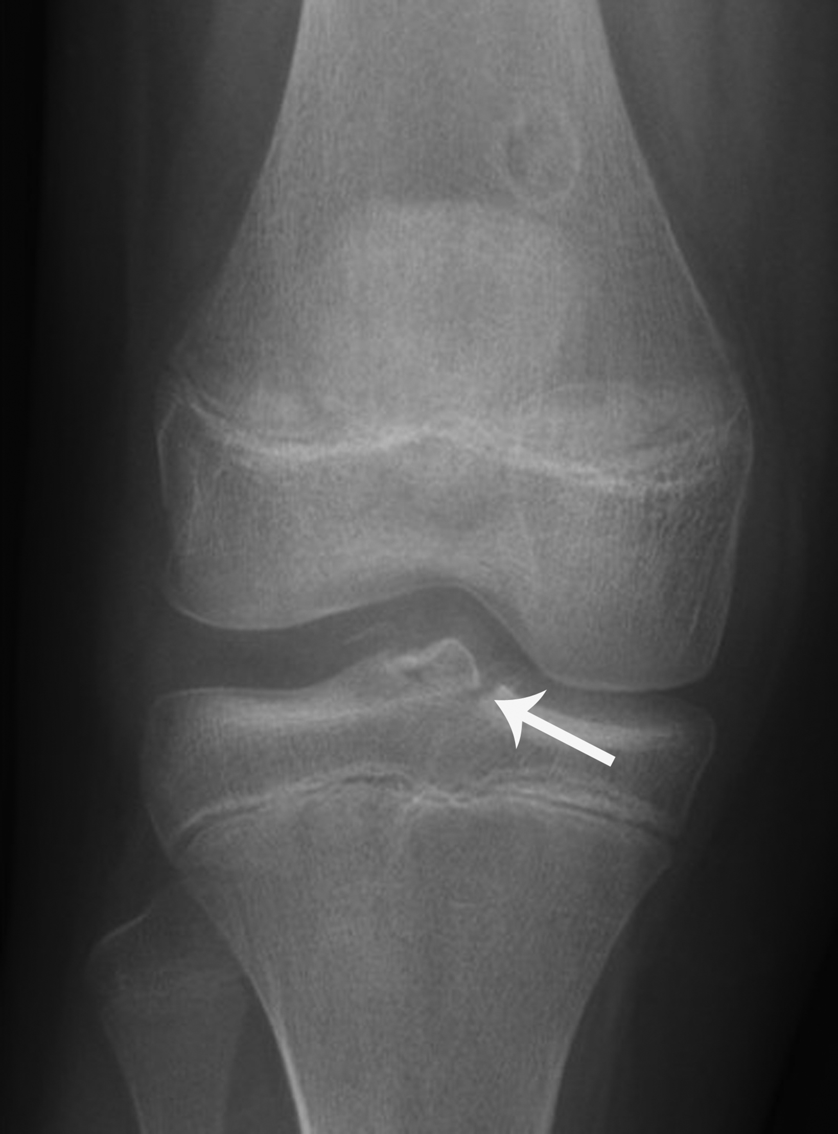 Lateral radiograph of the left tibia demonstrating the characteristic