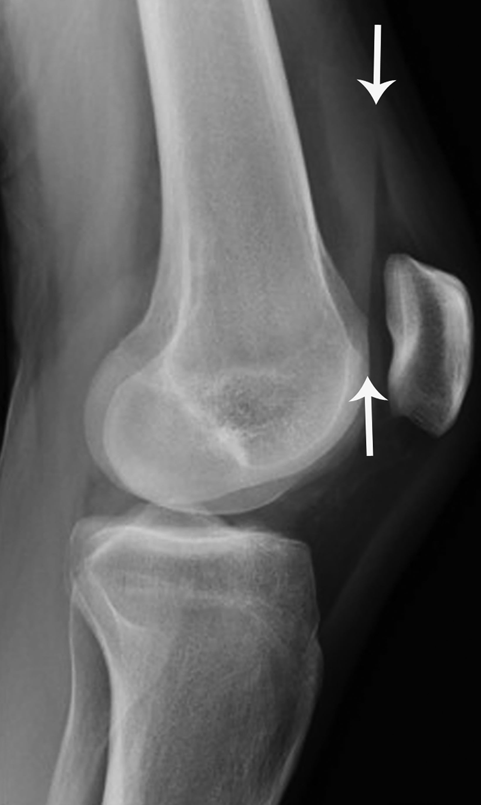 Knee deals cap xray