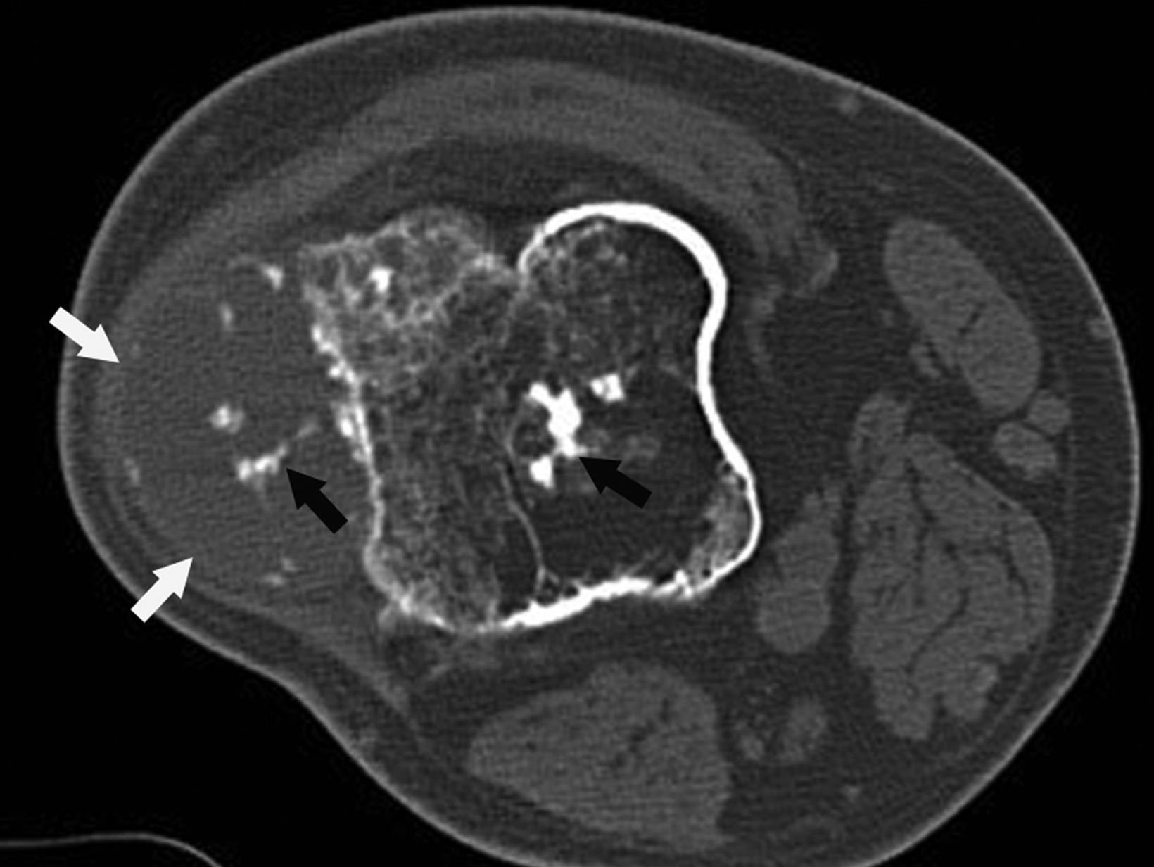 Osteochondroma-Related Pressure Erosions in Bony Rings Below the Waist