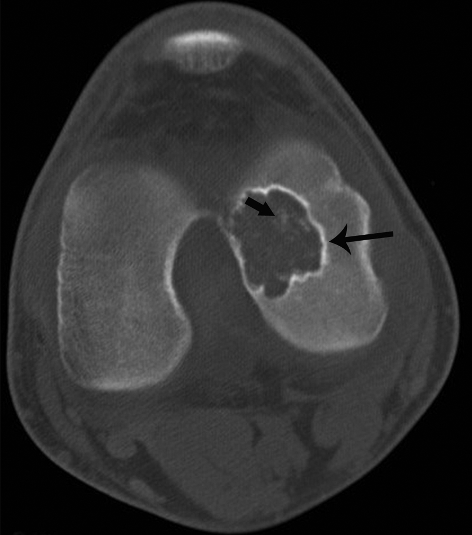 Osteochondroma-Related Pressure Erosions in Bony Rings Below the Waist