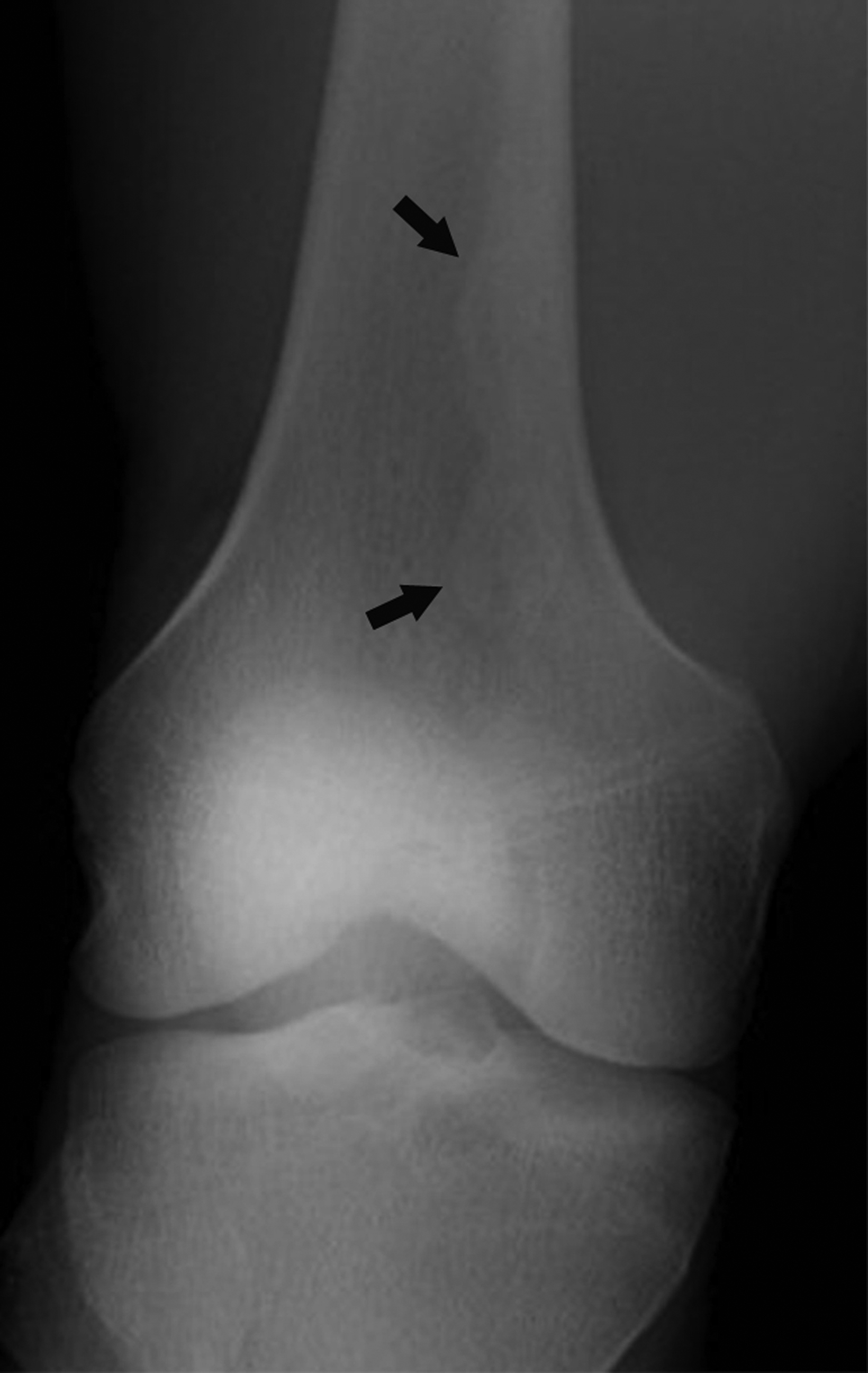 Osteochondroma-Related Pressure Erosions in Bony Rings Below the Waist