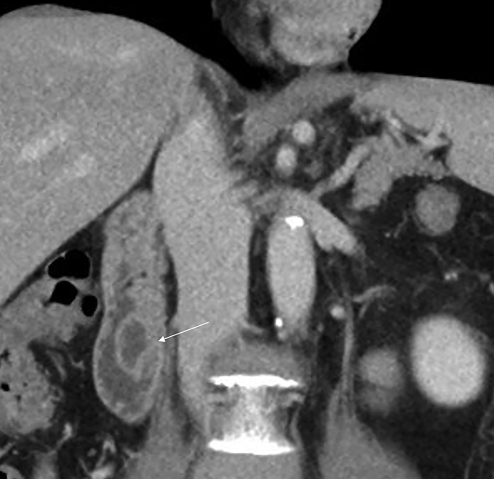 intraluminal-duodenal-diverticulum-applied-radiology