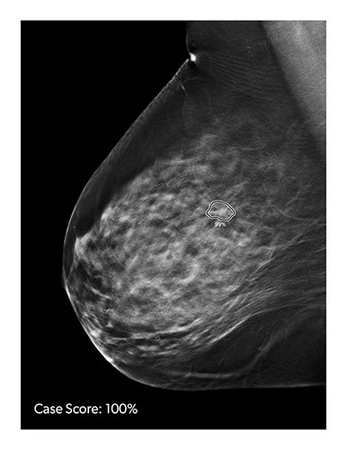 Small breast cancer, Radiology Case