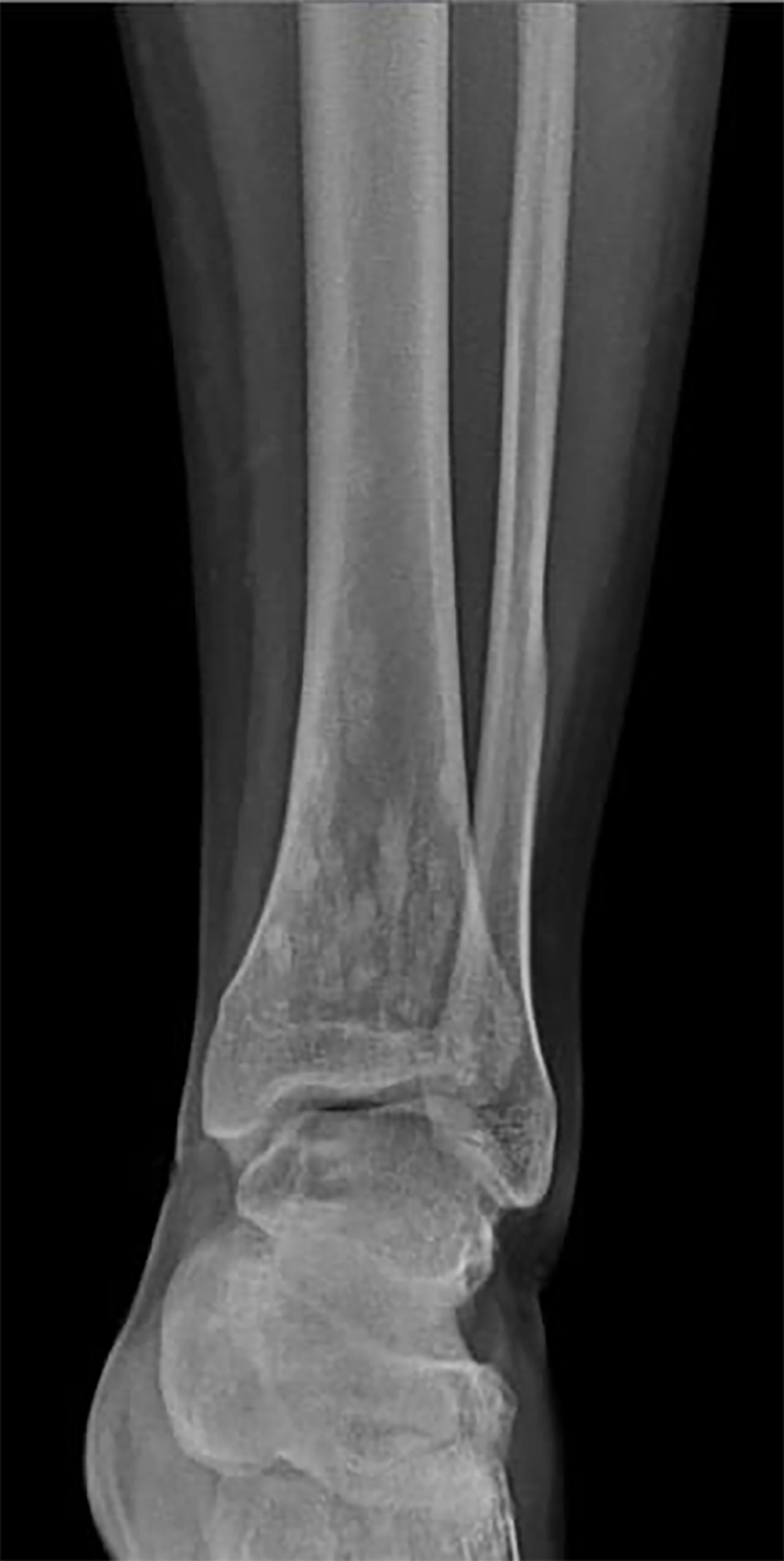 Melorheostosis and Osteopoikilosis | Applied Radiology