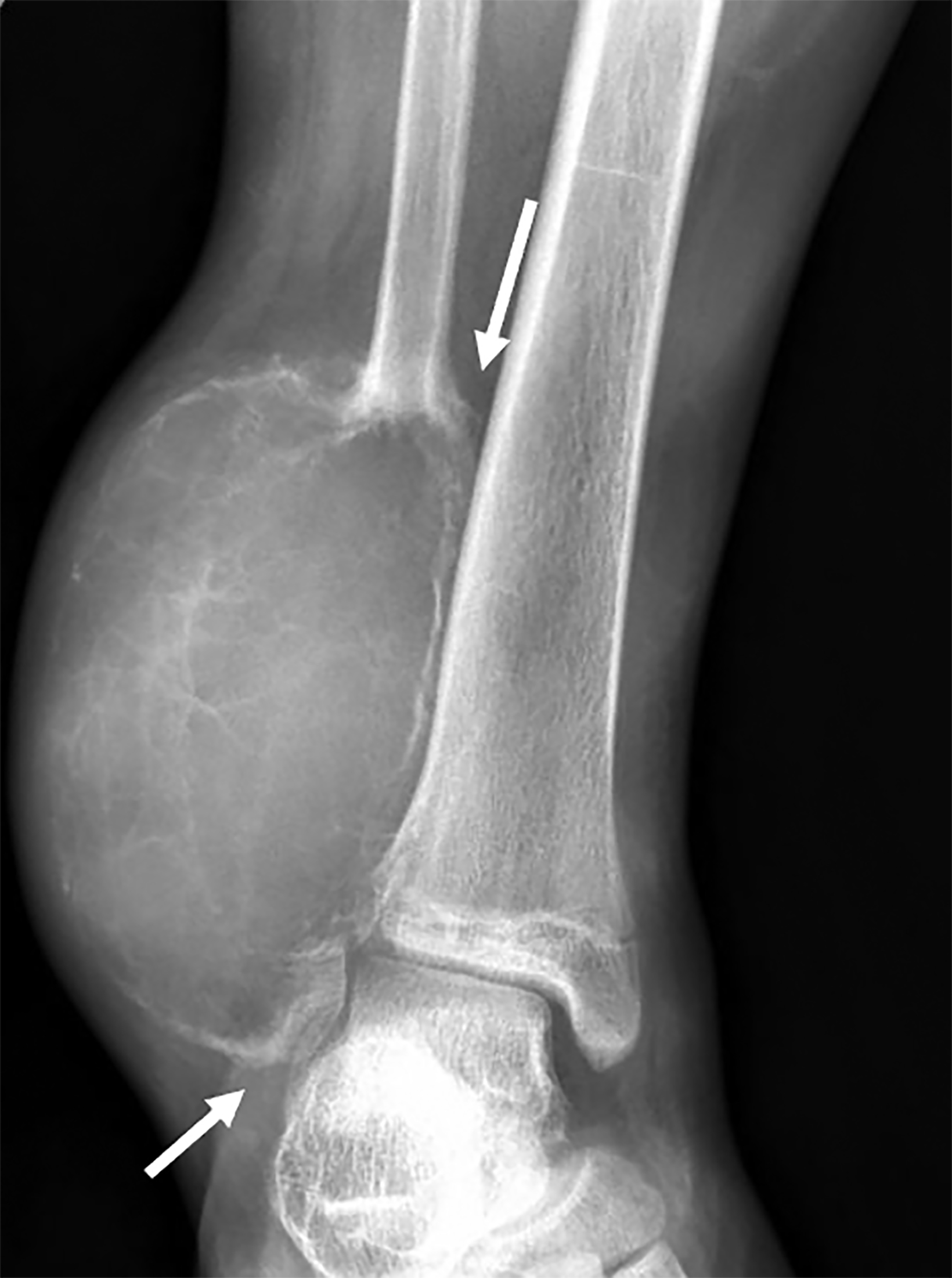 Aneurysmal Bone Cyst Tibia