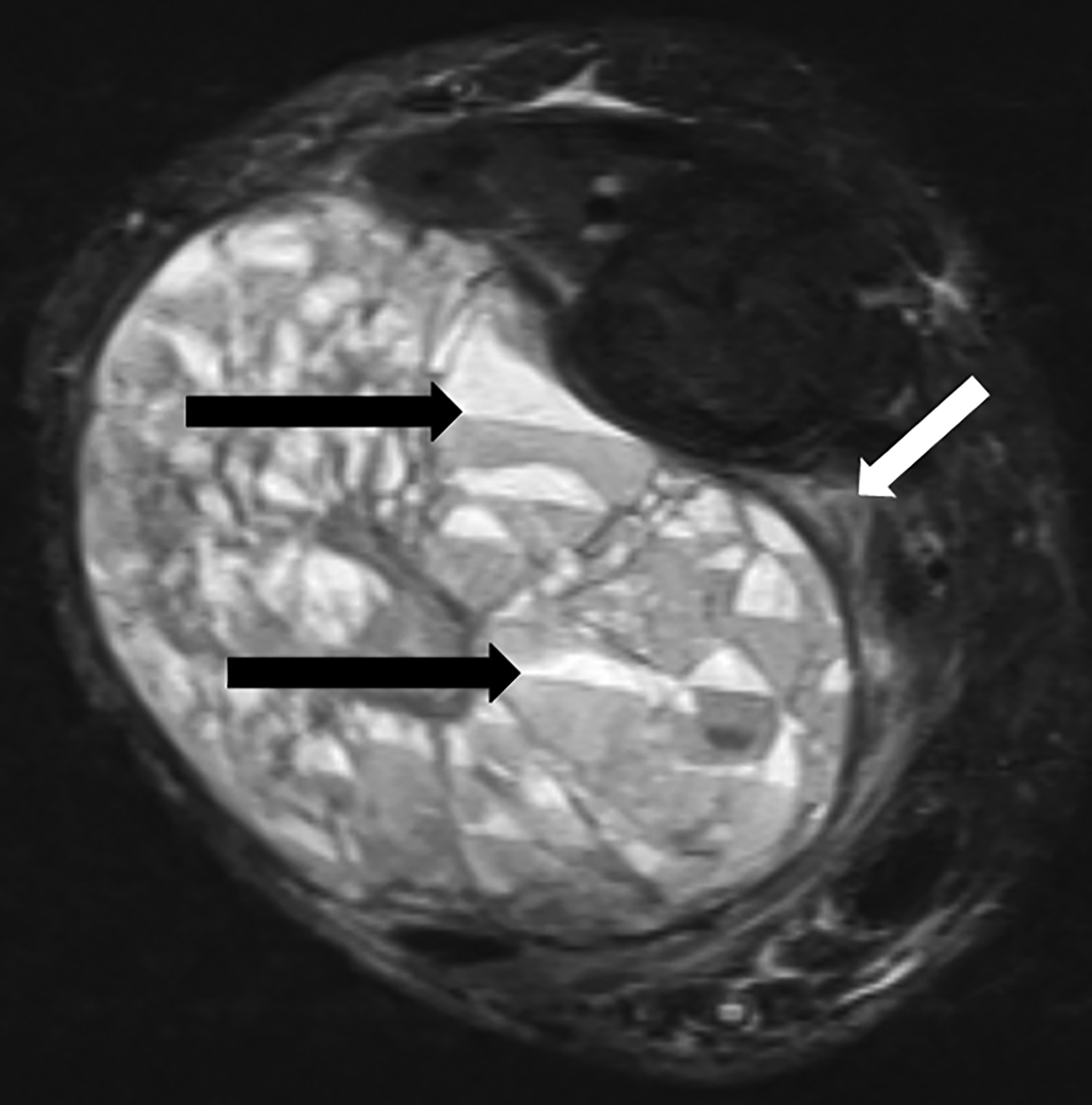 Aneurysmal Bone Cyst • Applied Radiology 3311