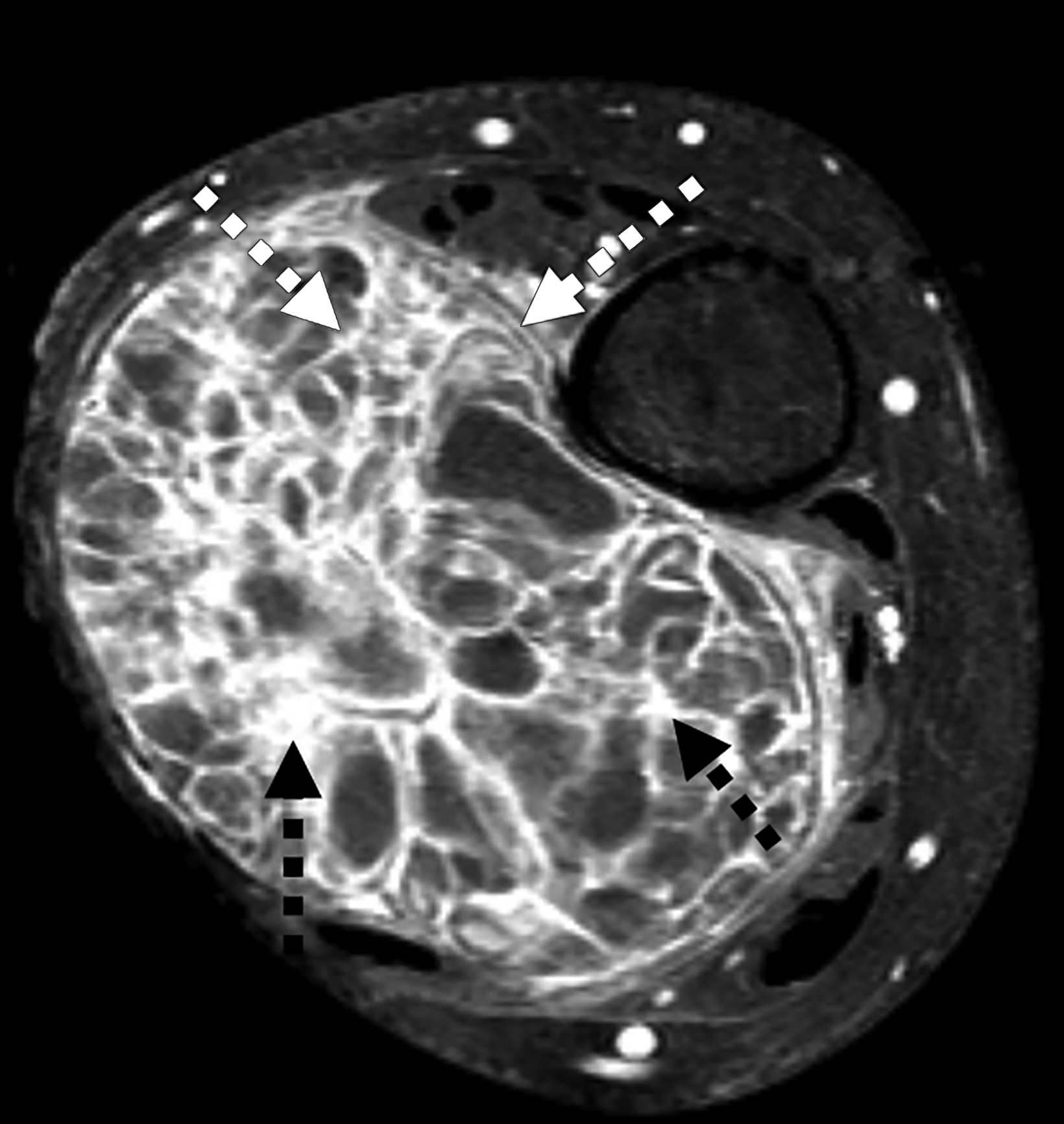 Aneurysmal Bone Cyst • Applied Radiology 0538