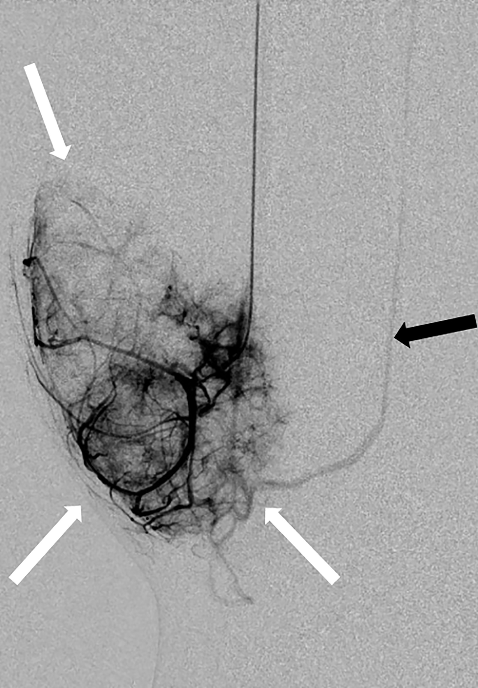 Aneurysmal Bone Cyst • Applied Radiology 8855