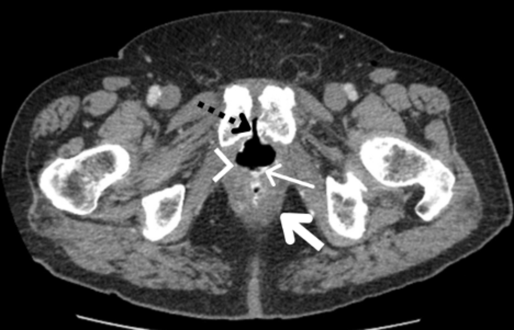 Rectourethral Fistula | ARYAN'S BLOG