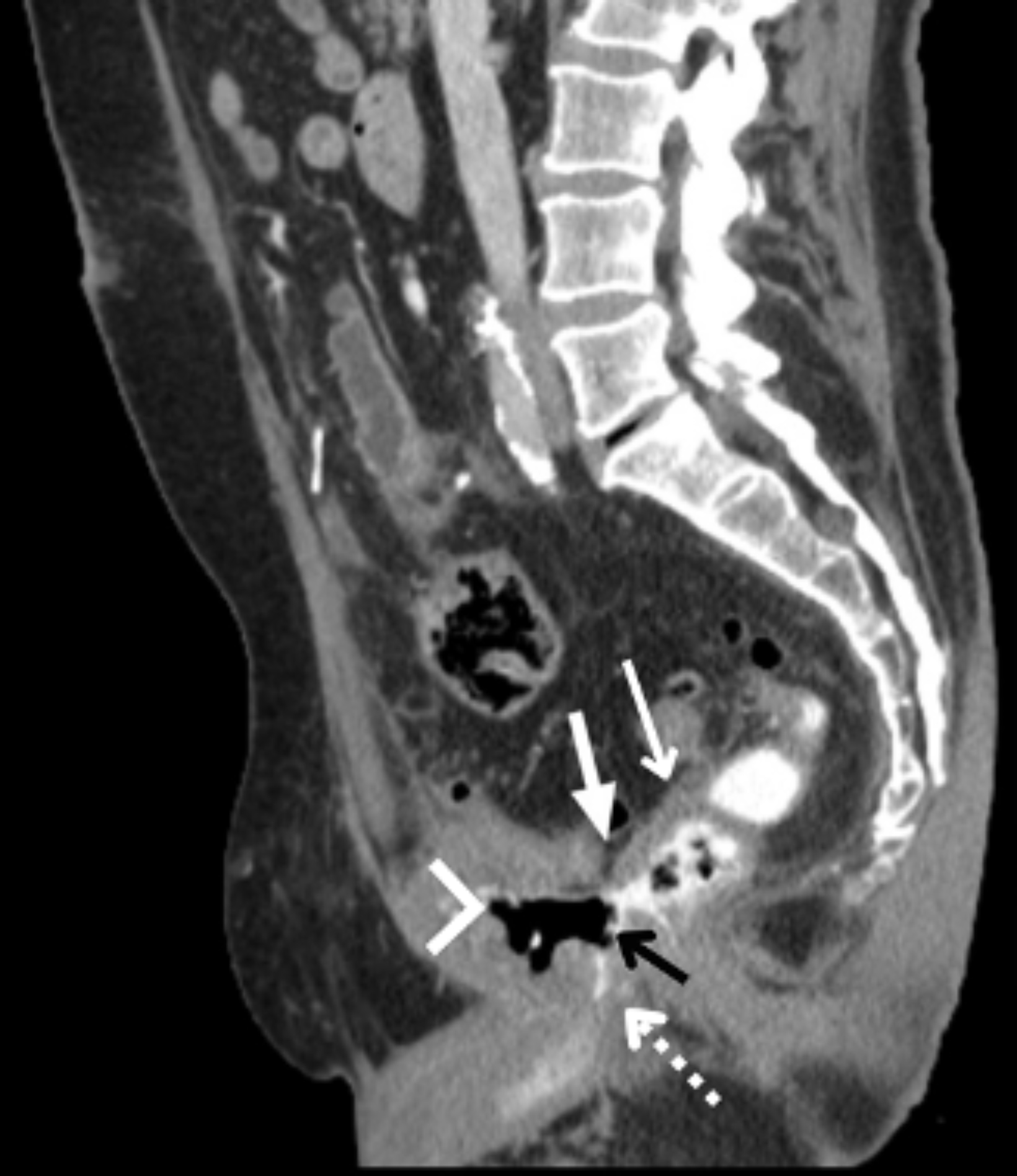 Rectourethral Fistula | ARYAN'S BLOG