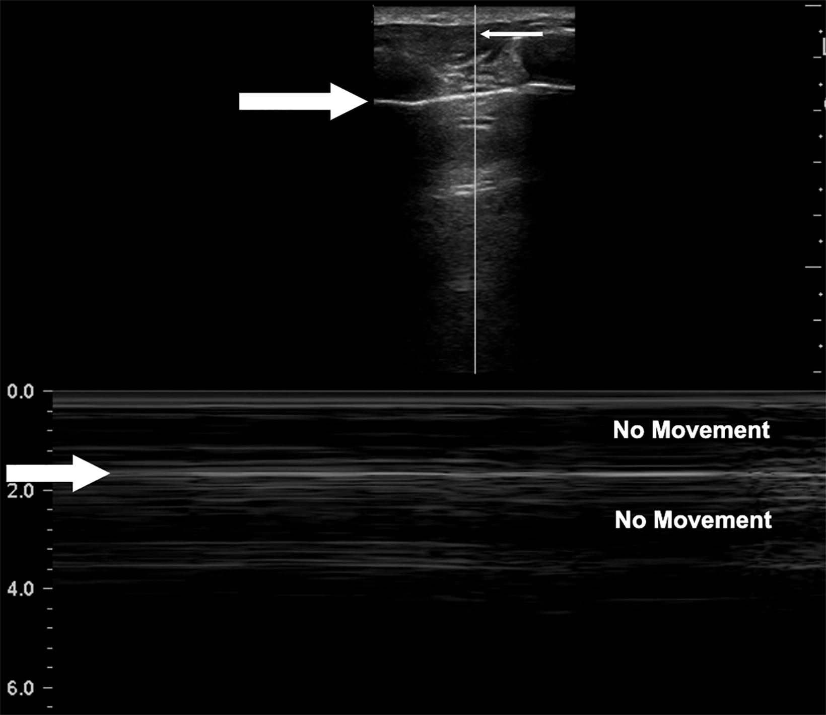 picture of pneumothorax m mode ultrasound