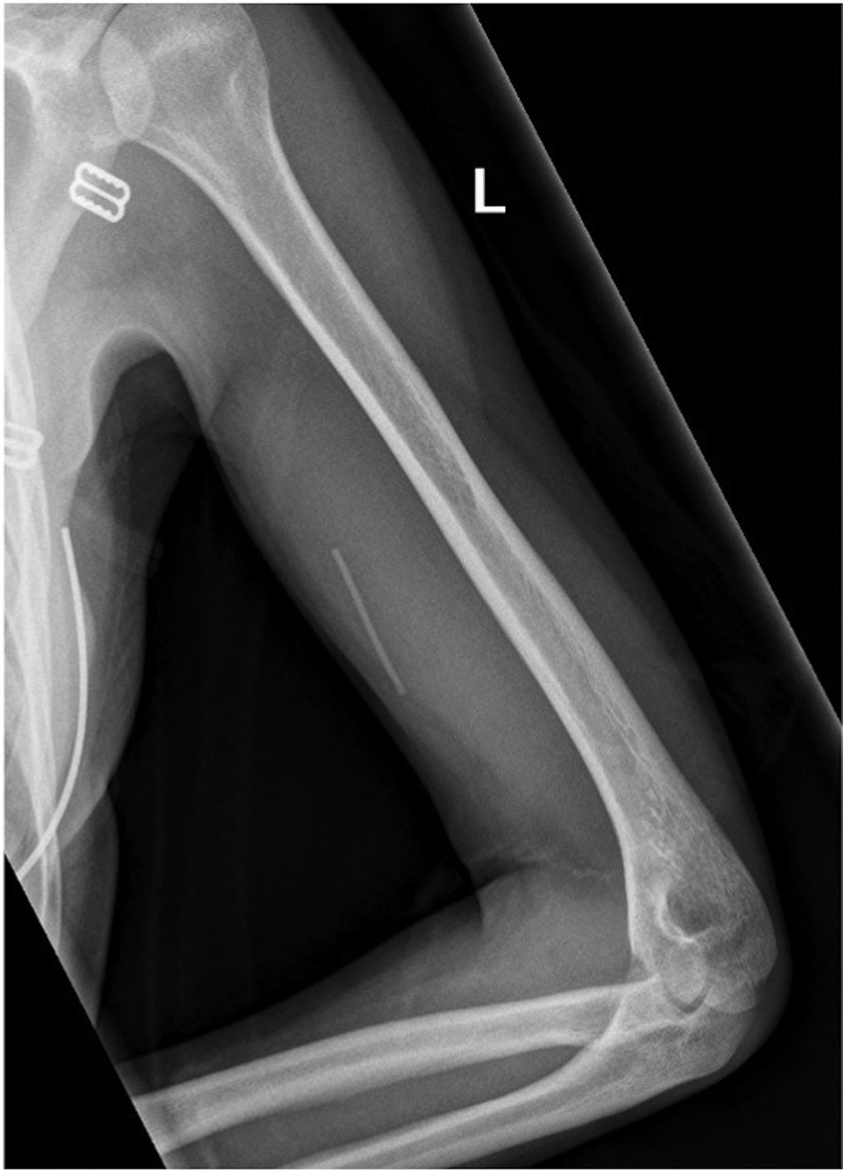 Subfascial‐located contraceptive devices requiring surgical