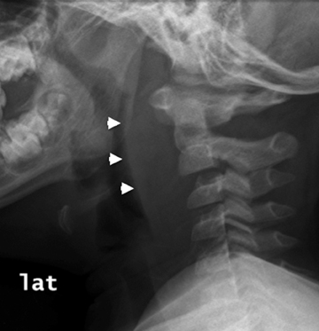 Pediatric emergencies of the upper and lower airway • APPLIED RADIOLOGY
