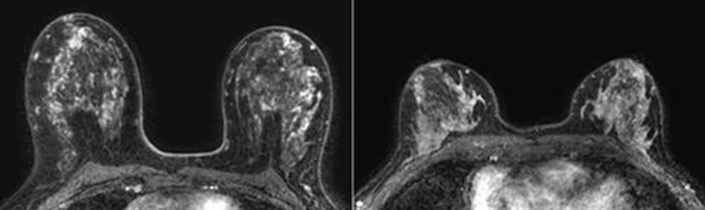 Background MRI Enhancement Increases Cancer Risk in Women With Very ...