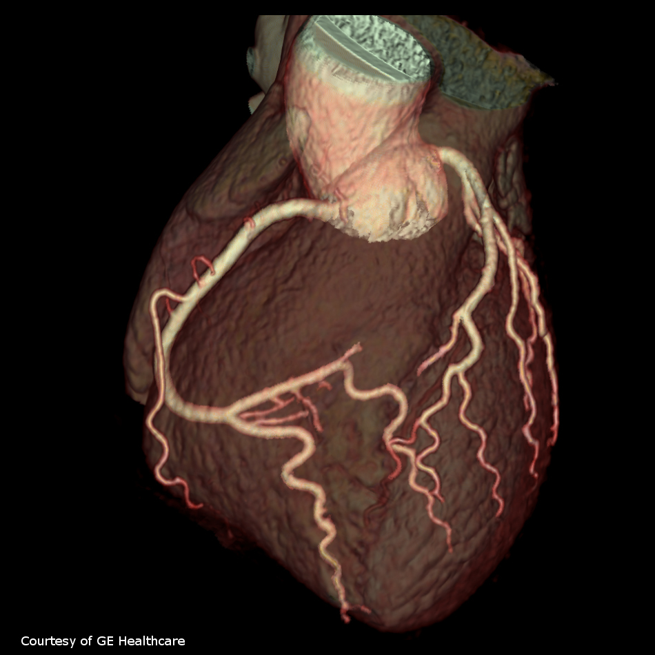 CMS Appropriate Use Criteria for Cardiac Imaging Creates Reimbursement