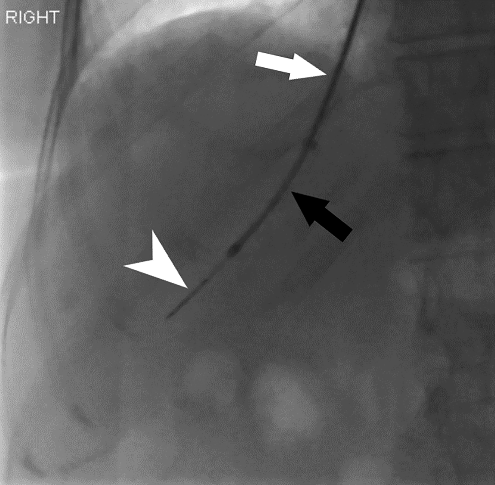 percutaneous-and-transvenous-liver-biopsy-applied-radiology