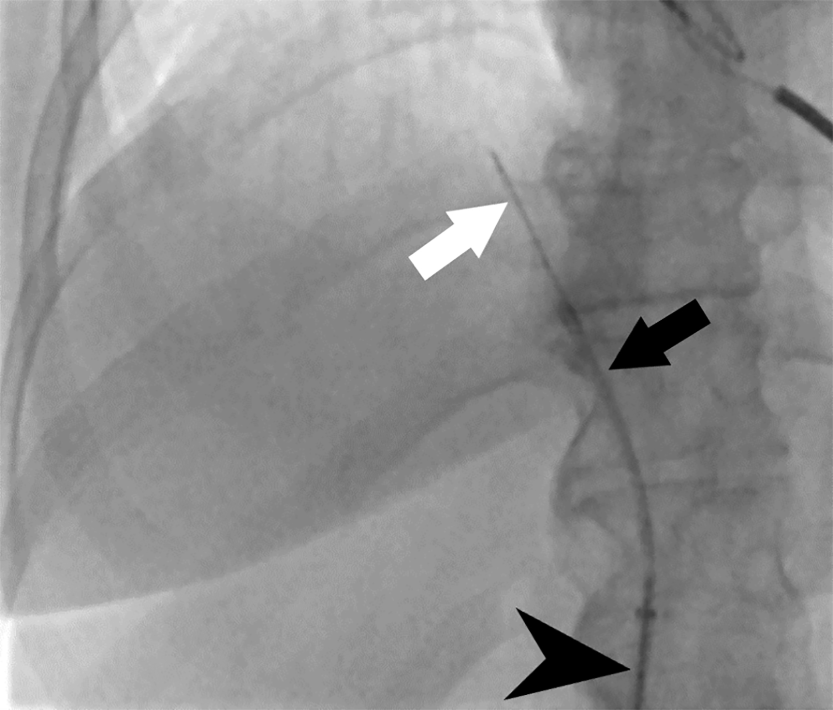 percutaneous-and-transvenous-liver-biopsy-applied-radiology