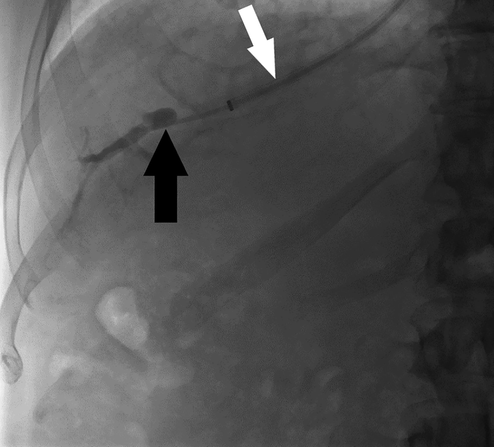 percutaneous-and-transvenous-liver-biopsy-applied-radiology