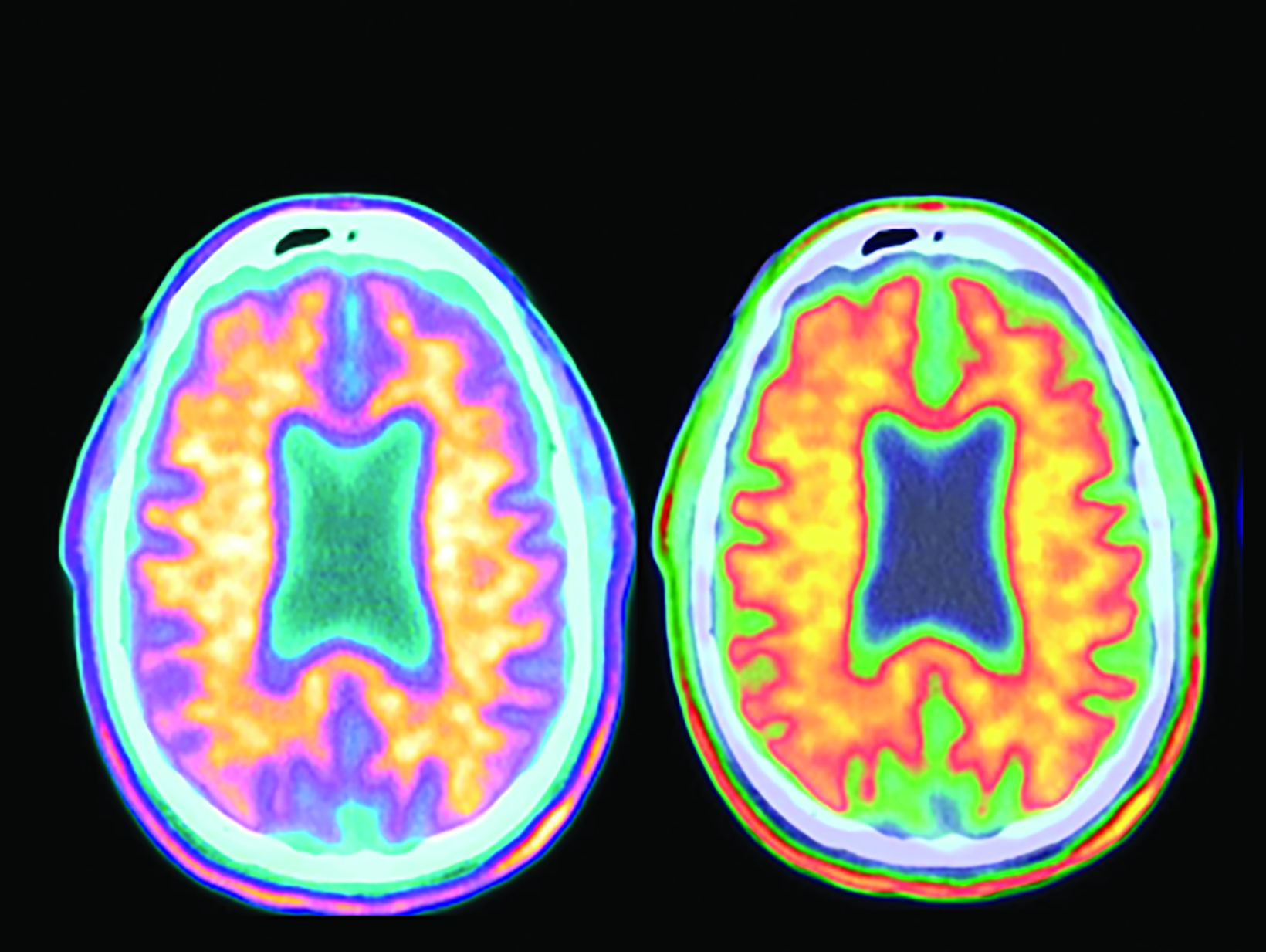 Alzheimer Disease Imaging in the Era of Anti-Amyloid Treatment ...