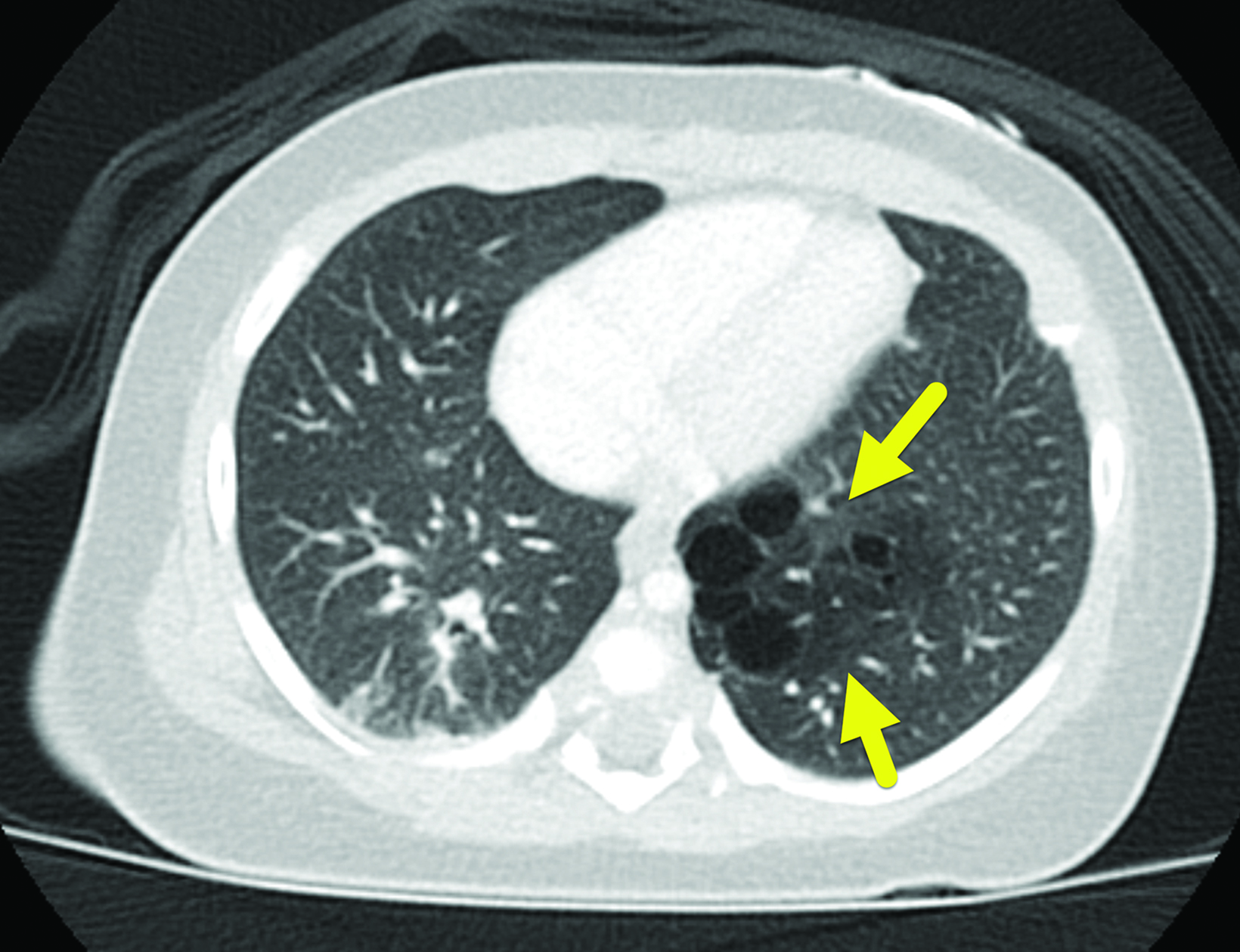 Cureus Congenital Pulmonary Airway Malformation In An Adult, 54% OFF